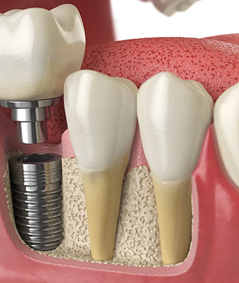 Dental implant structure showing titanium root and custom crown