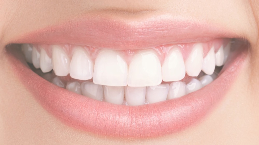 Teeth before restoration treatment at Adelaide Dental Spa