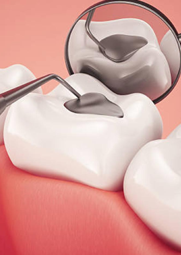 Detail showing metal filling replacement on tooth